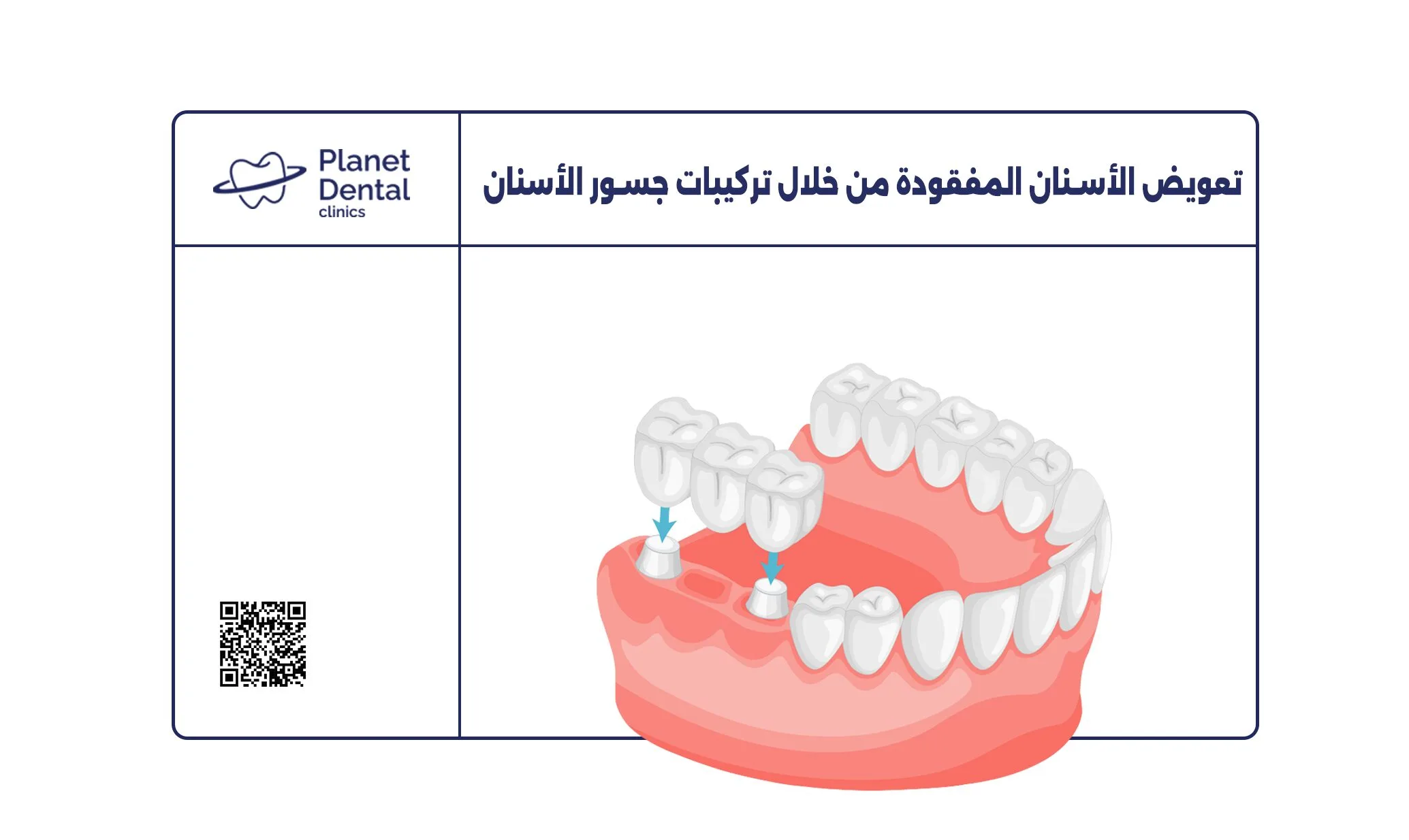 تعويض الأسنان المفقودة من خلال تركيبات جسور الأسنان