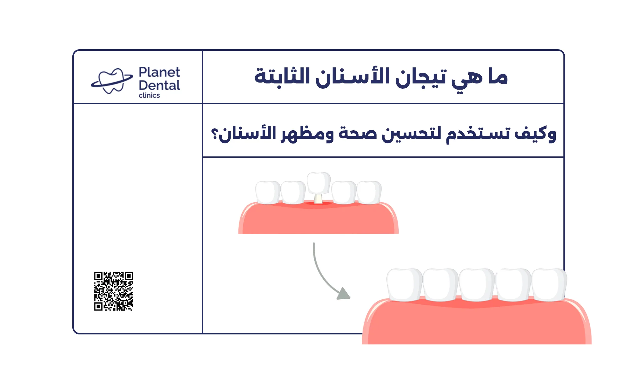 ما هي تيجان الأسنان الثابتة وكيف تستخدم لتحسين صحة ومظهر الأسنان؟